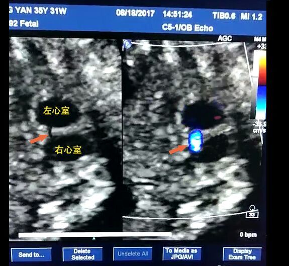 高龄产妇,孕31周 ,胎儿先天性心脏病:室间隔缺损