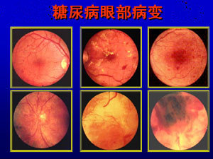 高血糖对眼睛造成的伤害,眼部病变的过程