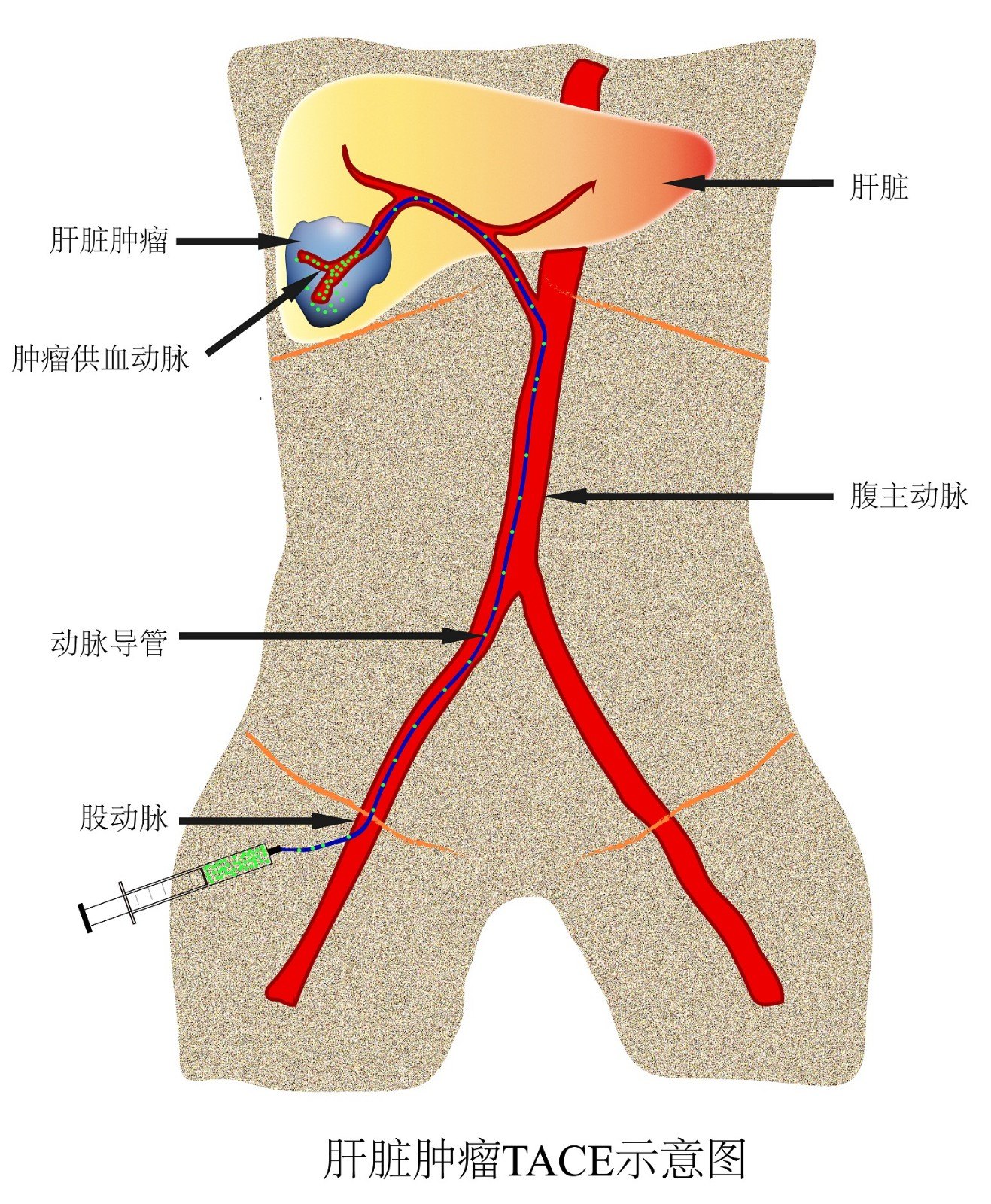 TACE示意图.jpg