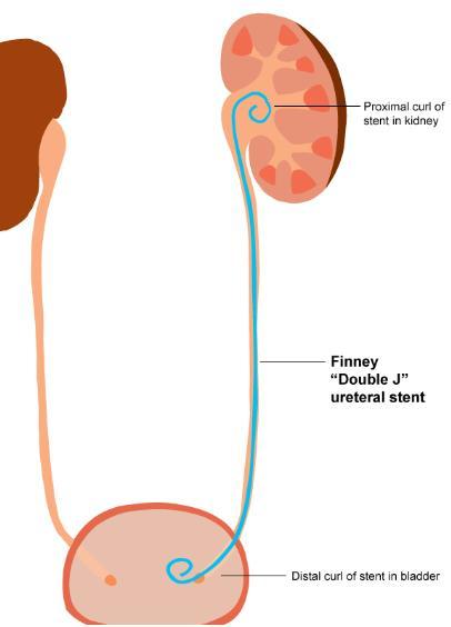 输尿管结石微创(钬激光碎石)术后必读!_输尿管