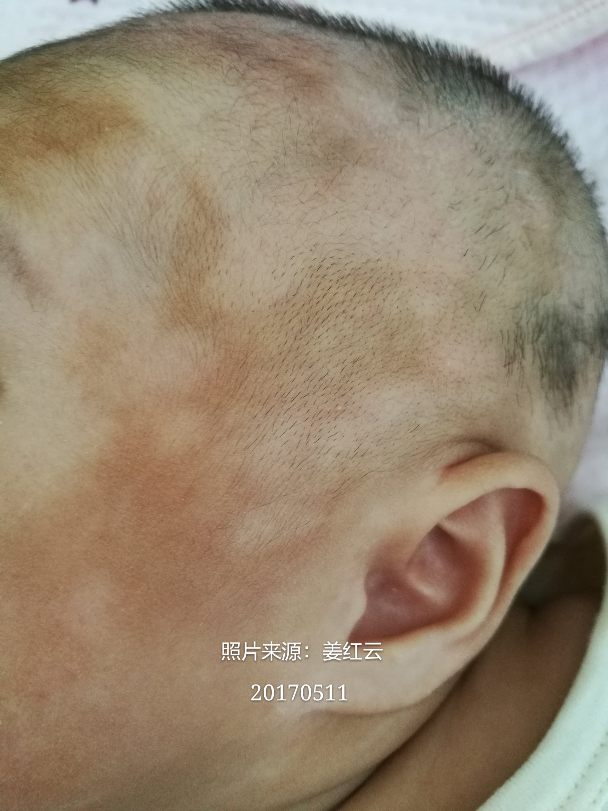 是白癜风还是炎症后色素减退斑?_好大夫在线