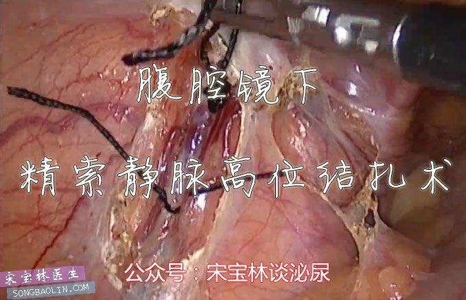 腹腔镜下精索静脉高位结扎术1.jpg