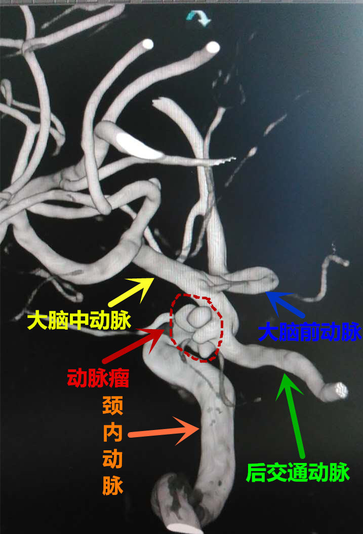 左侧翼点开颅后交通段动脉瘤夹闭术