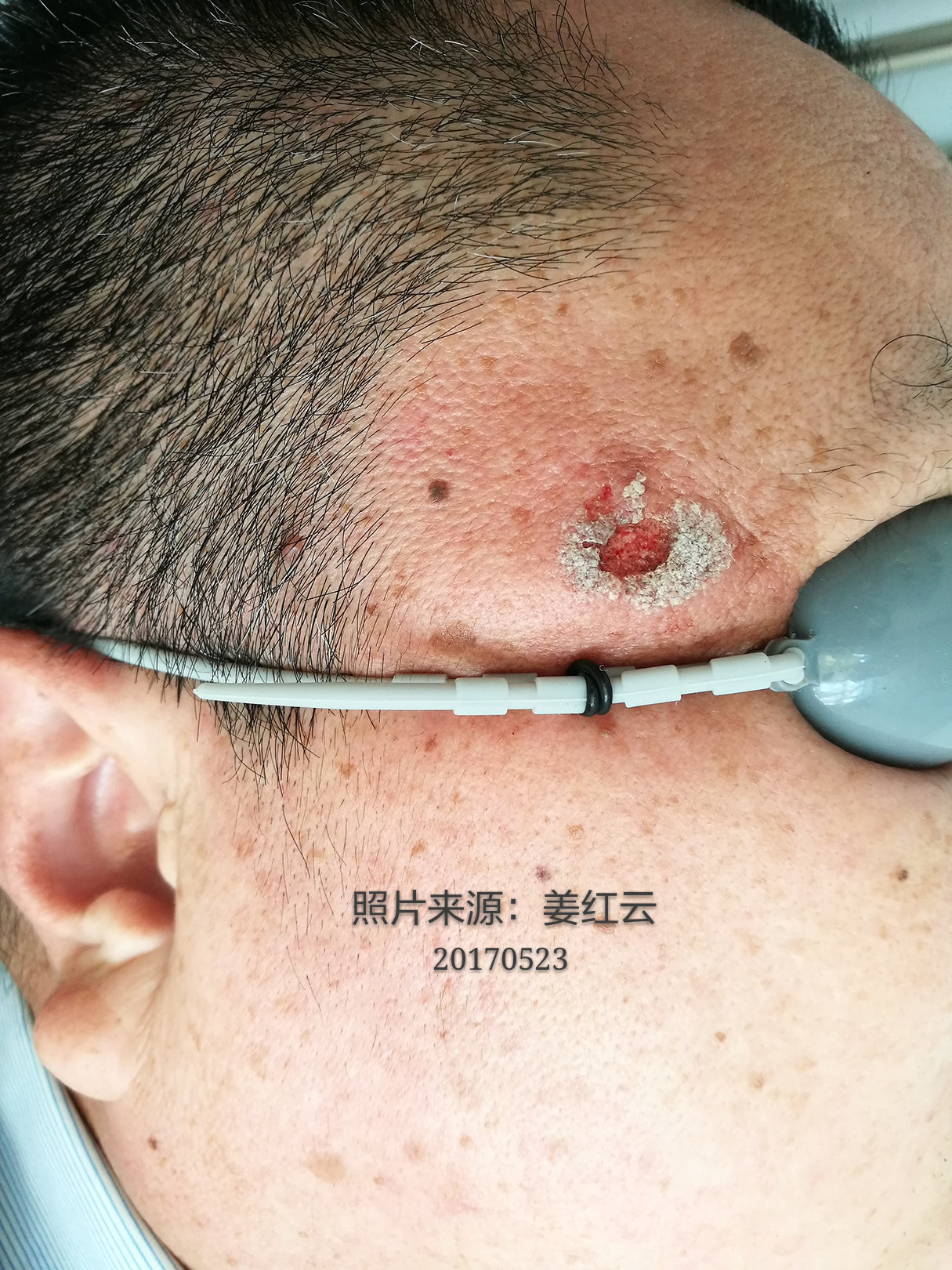 老年斑上又长了老年疣,该如何治疗呢?