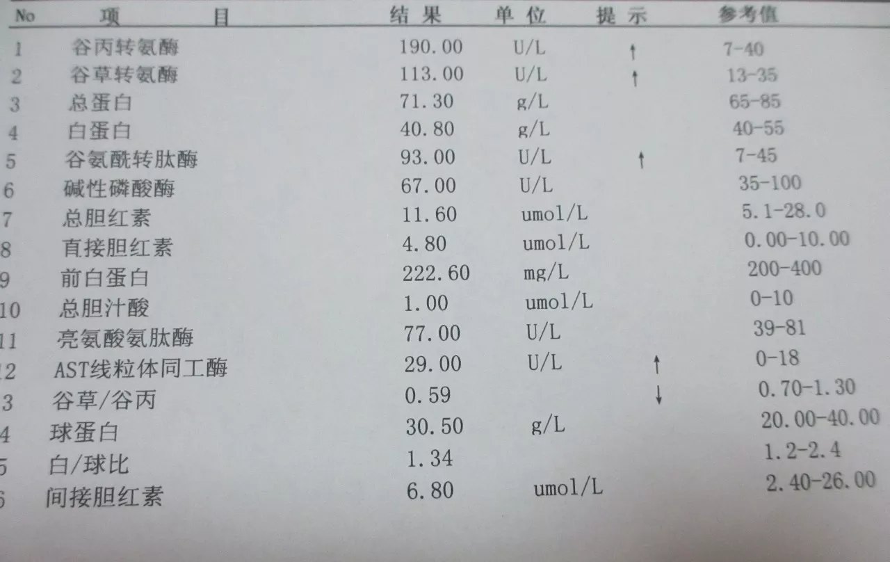 酒精性肝炎:未作活检,应符合下列诊断依据和附加项目中3项或以上.