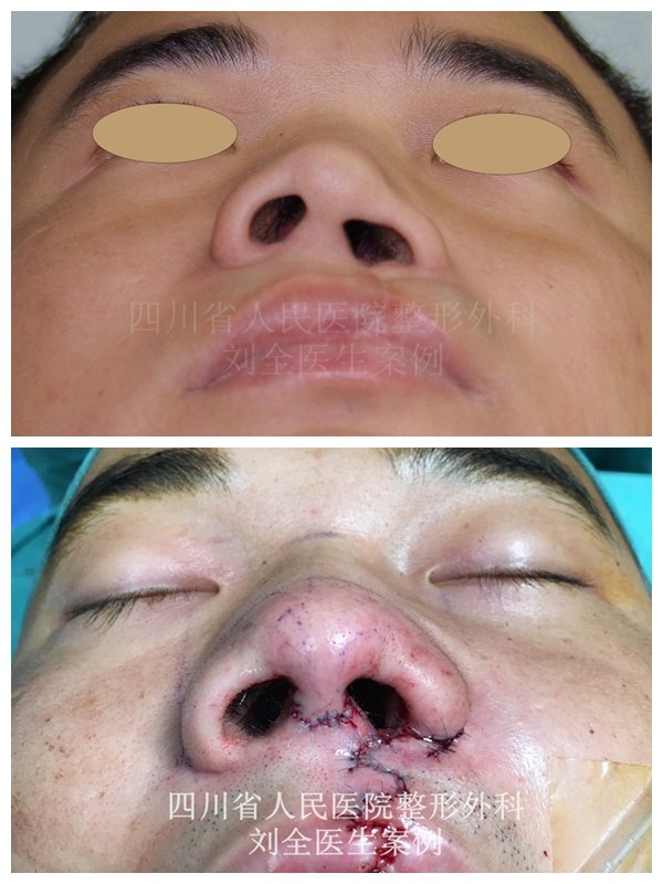 一期唇裂畸形手术时机通常选择在出生后3个月,充分的一期修复,能够