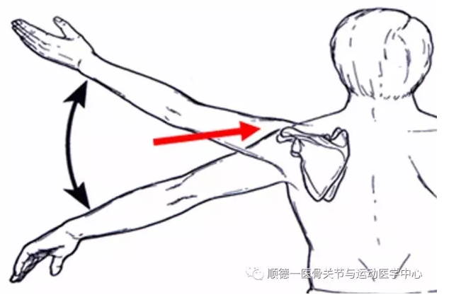 不是所有的肩部疼痛都叫肩周炎一肩峰下撞击症