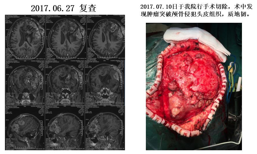 治疗恶性脑膜瘤一例