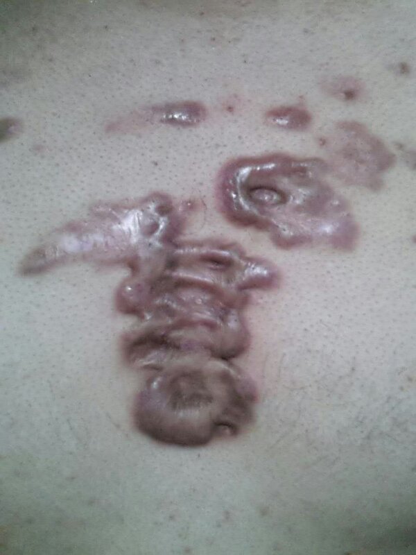 治疗瘢痕疙瘩首选同位素敷贴治疗(山东青岛) -