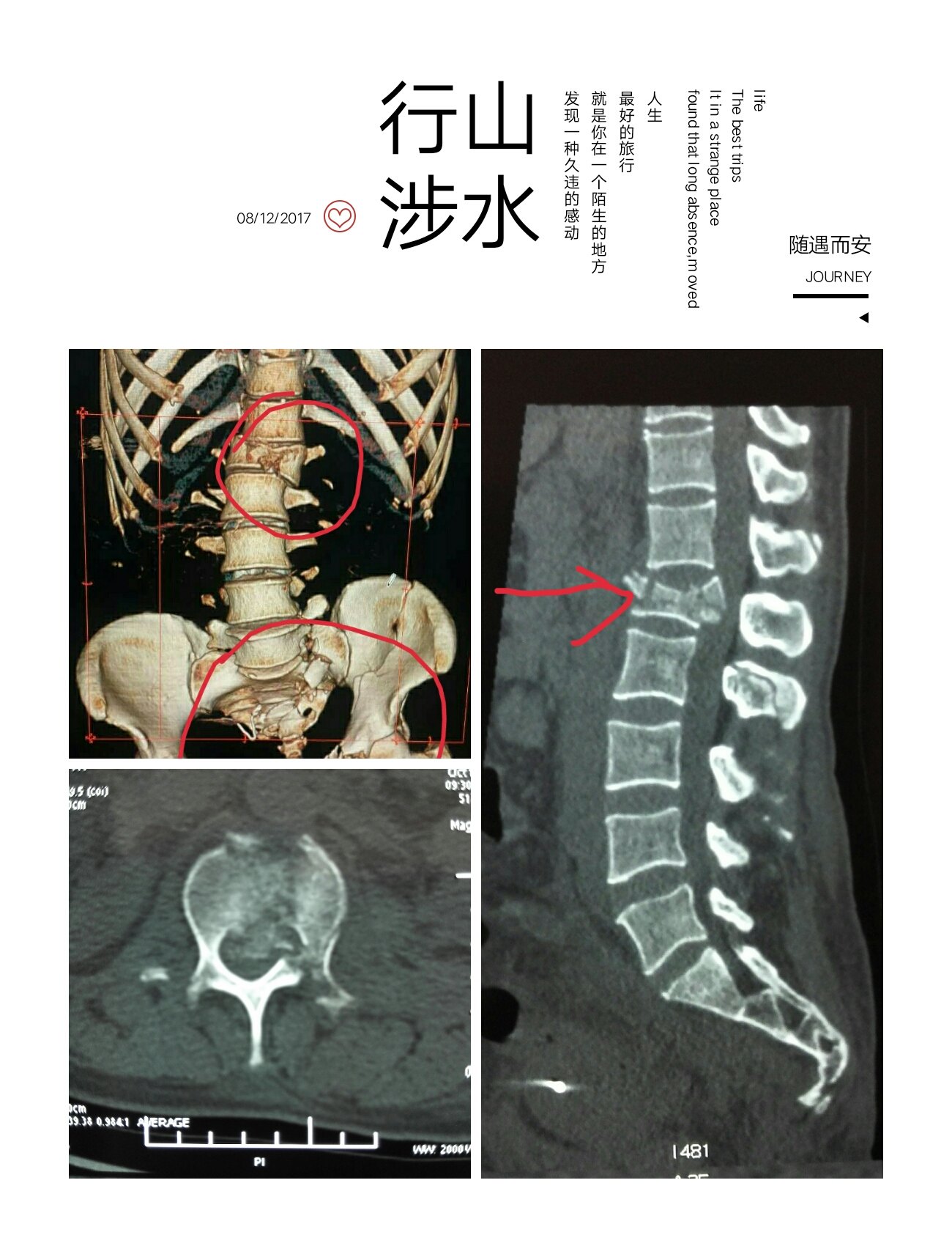 脊柱爆裂骨折,骨盆髋臼骨折不全瘫 (原创)