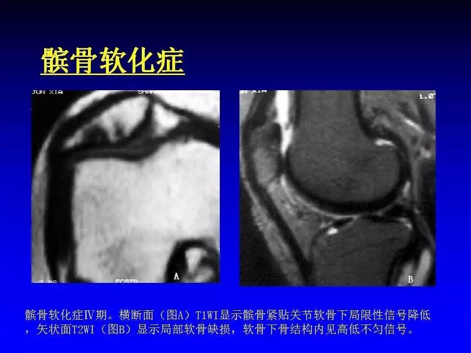 髌骨软化症