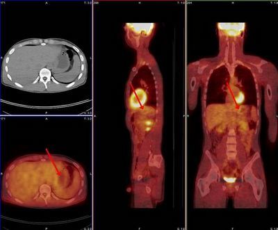 1513502411281162.jpg PETCT.jpg