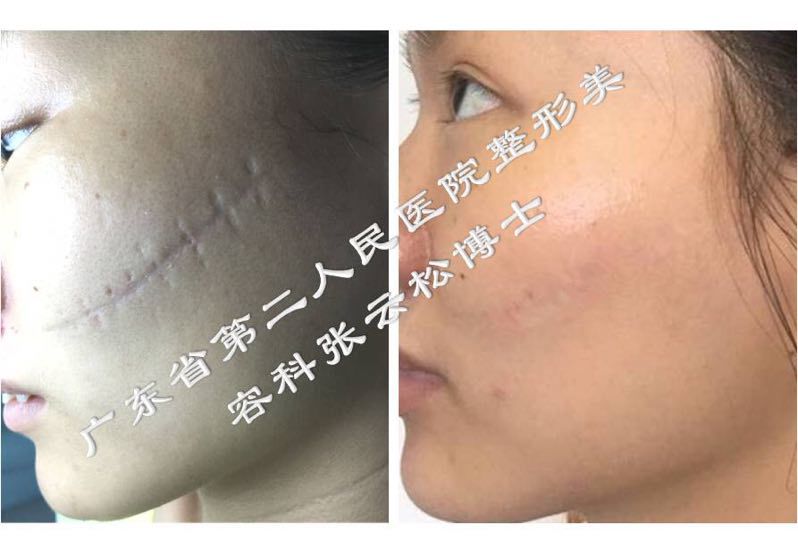 凹陷性疤痕修复对比照
