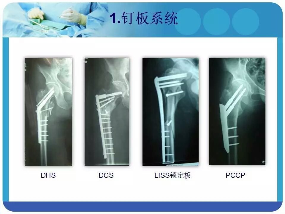pfna治疗股骨粗隆间骨折,让你看明白
