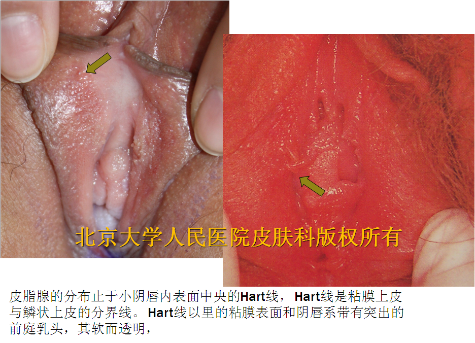 绒毛状假性疣高清图片