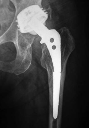 我的人工全髋关节置换翻修手术需要做大粗隆延