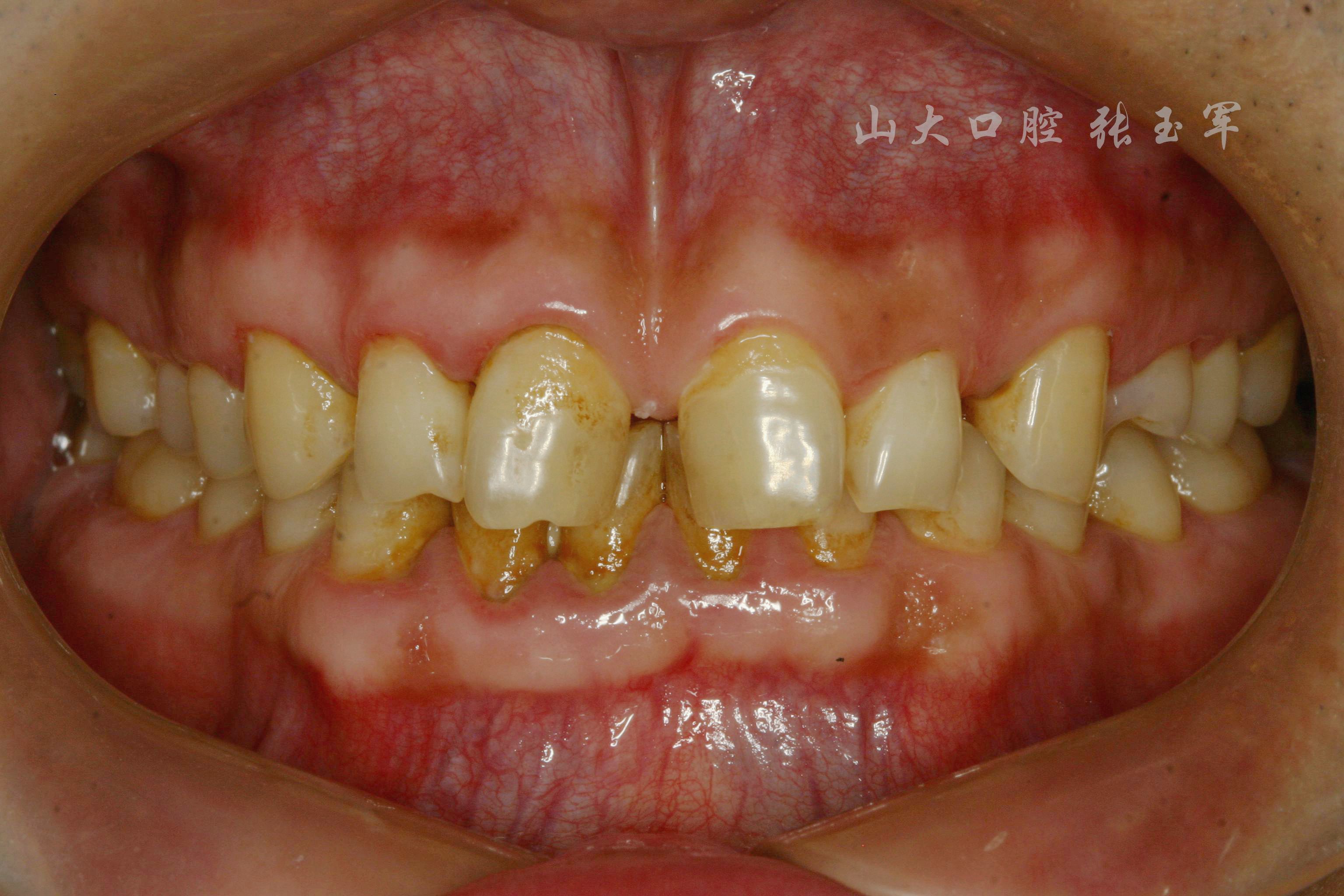 前牙贴面修复一例