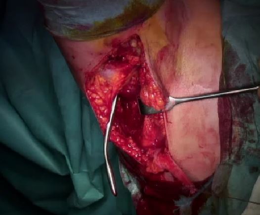 膀疼痛巨大肩袖撕裂能做关节镜辅助下背阔肌腱