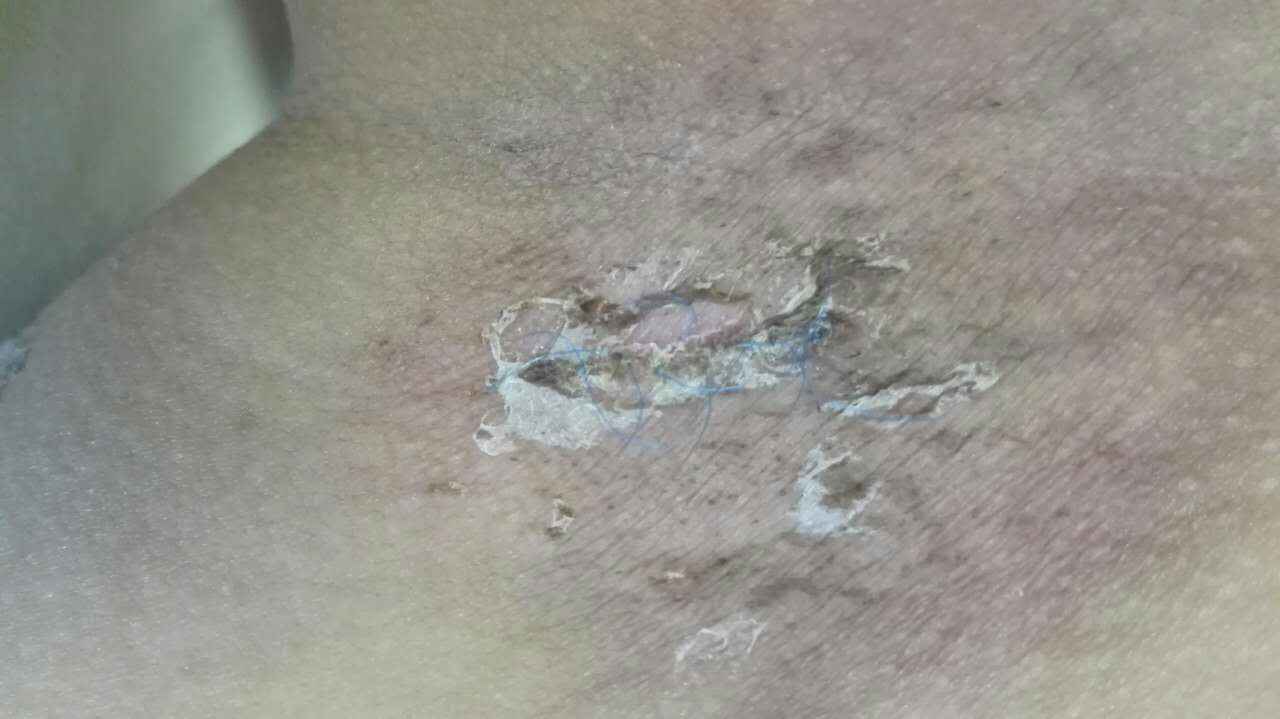 腋臭手术后伤口的常见情况及其处理原则_腋臭