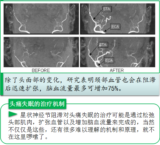 头痛失眠的新选择--星状神经节阻滞