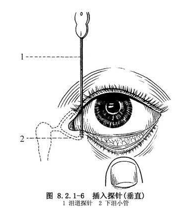 流泪有眼屎的孩子需要冲洗泪道?泪道系列之一(邓医生经验