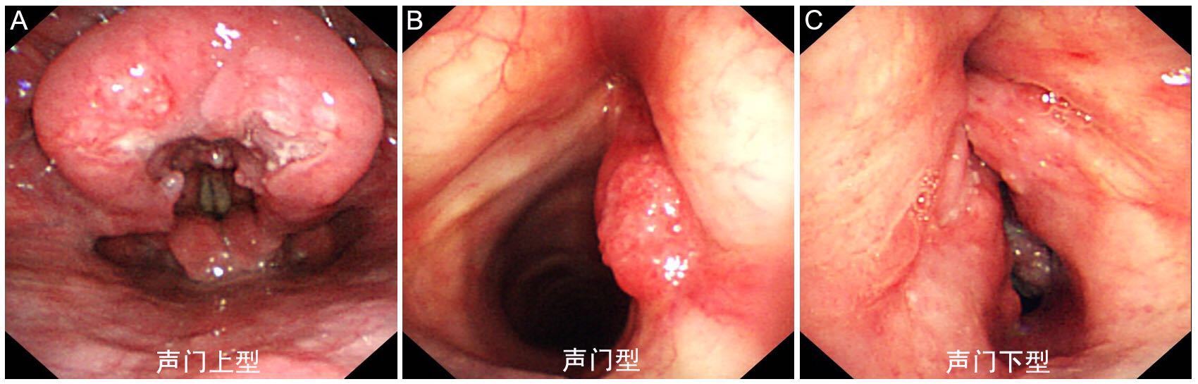 倪晓光 文章列表  6 ,外伤:如喉部外伤,包括环杓关节脱位(部分患者
