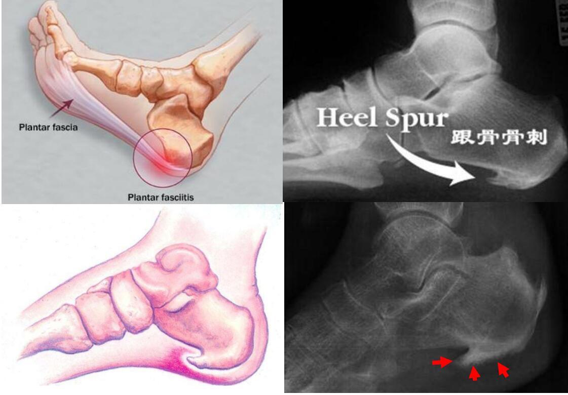 图7 跟骨骨刺X片及图解.jpg