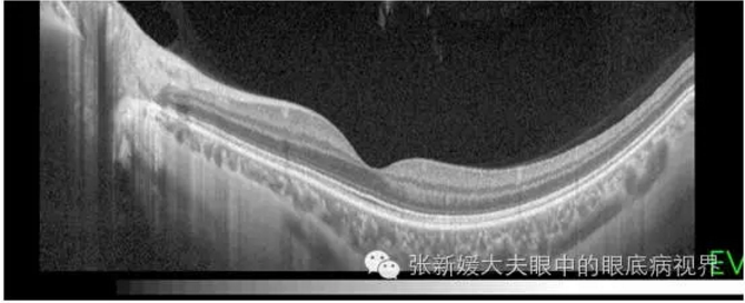 OCT究竟是什么鬼_眼部疾病_眼部疾病检查 - 好