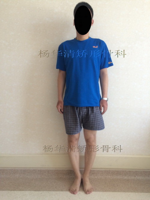 o型腿手术矫治膝内翻病例