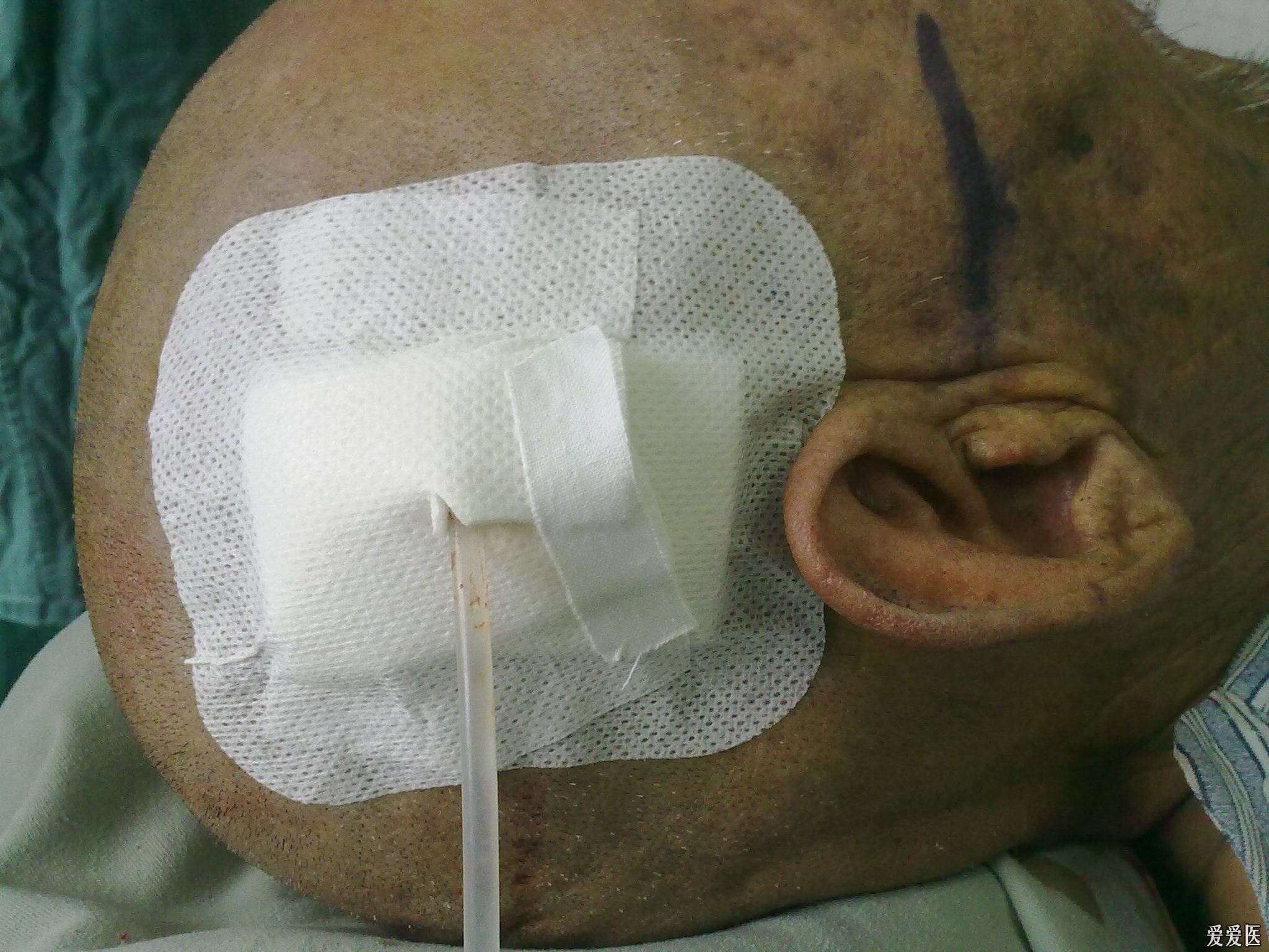 慢性硬膜下血肿患者须知 - 好大夫在线