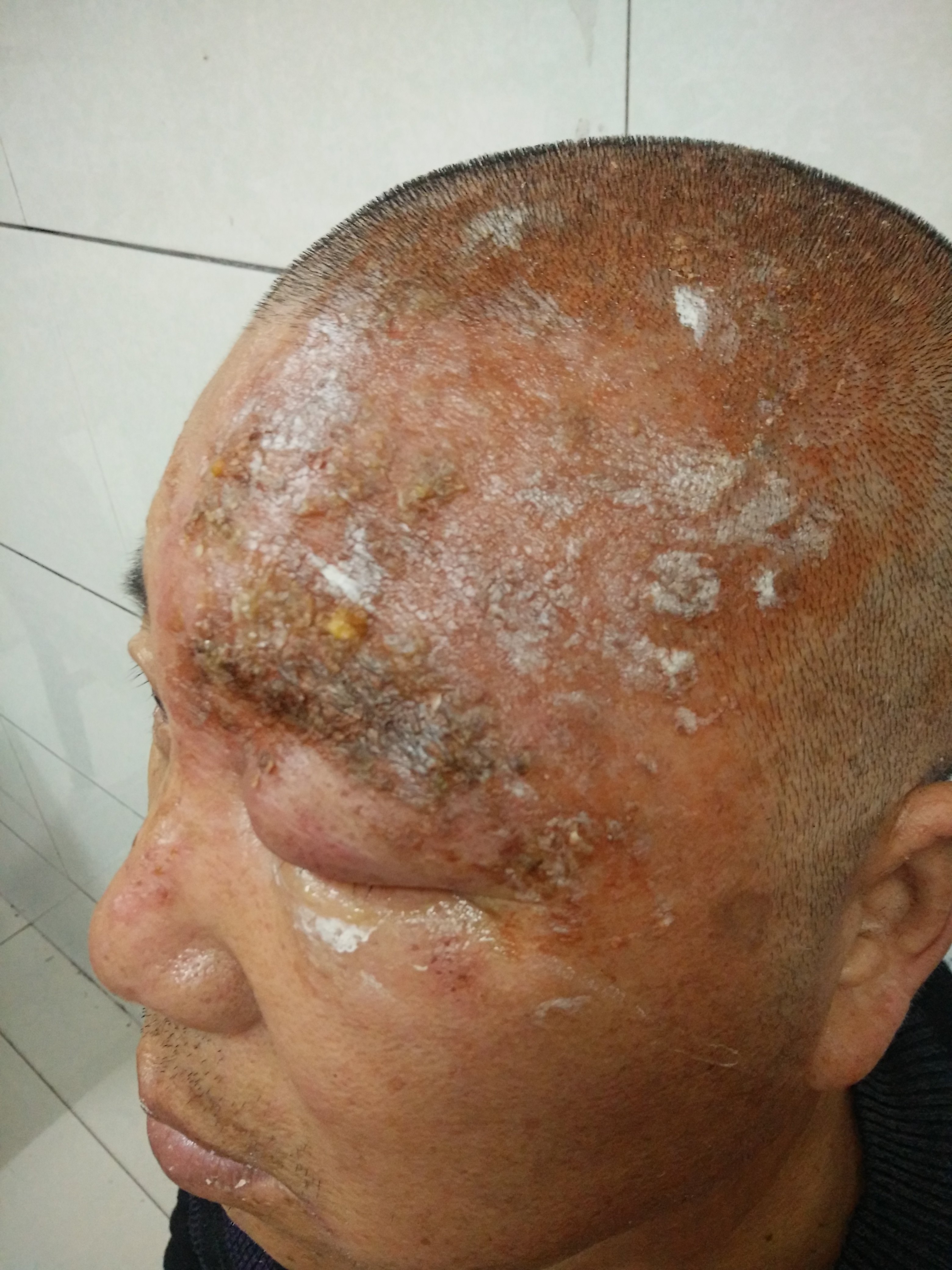 眼睑带状疱疹及引起的病毒性角膜炎的经验治疗.