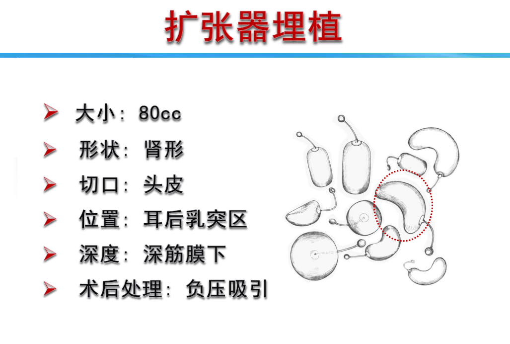 小耳畸形科普文章:我是如何造耳朵的(三 扩张器置入术