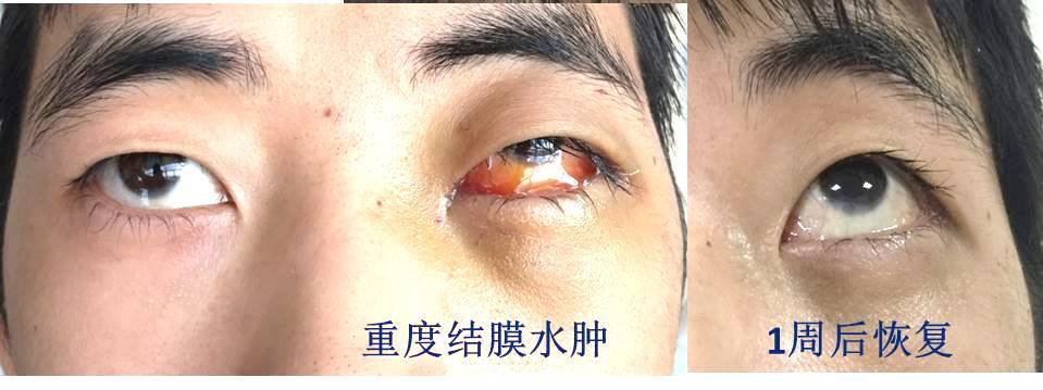 眼眶骨折术后眼白发黄发红多久能恢复?