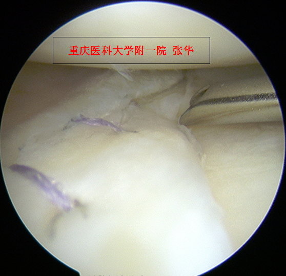 半月板桶柄样陈旧撕裂