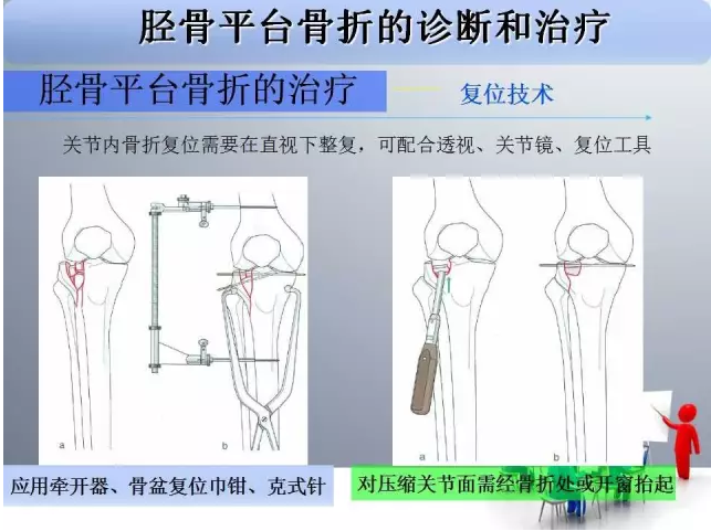 胫骨平台骨折的诊断与治疗技巧