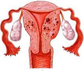 对话子宫腺肌病,为什么首选海扶刀(HIFU)无创