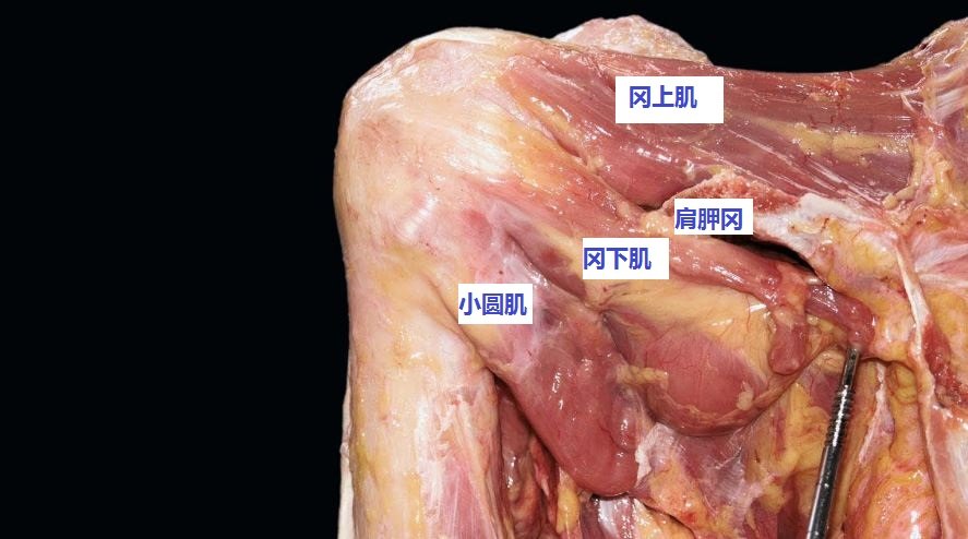 什么是后上方肩袖撕裂