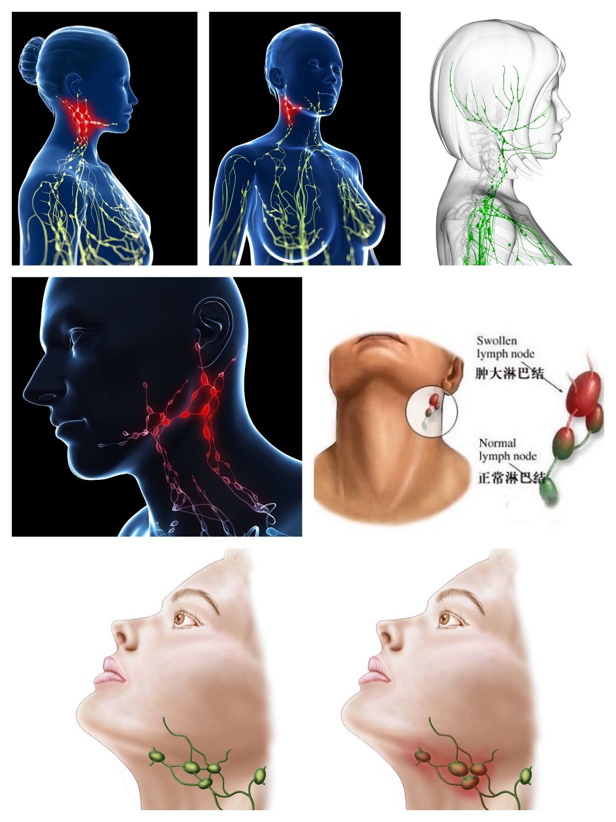 命运多舛的颈部淋巴结