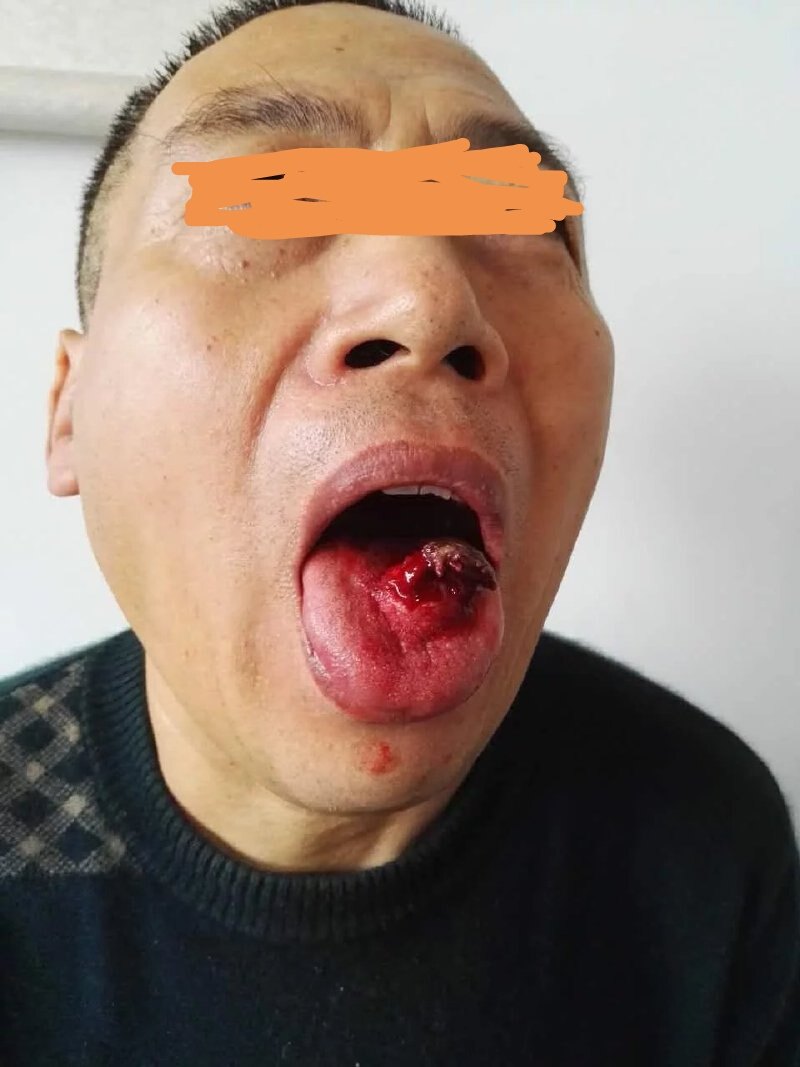 10个最容易被忽视的癌症早期信号! (转载)