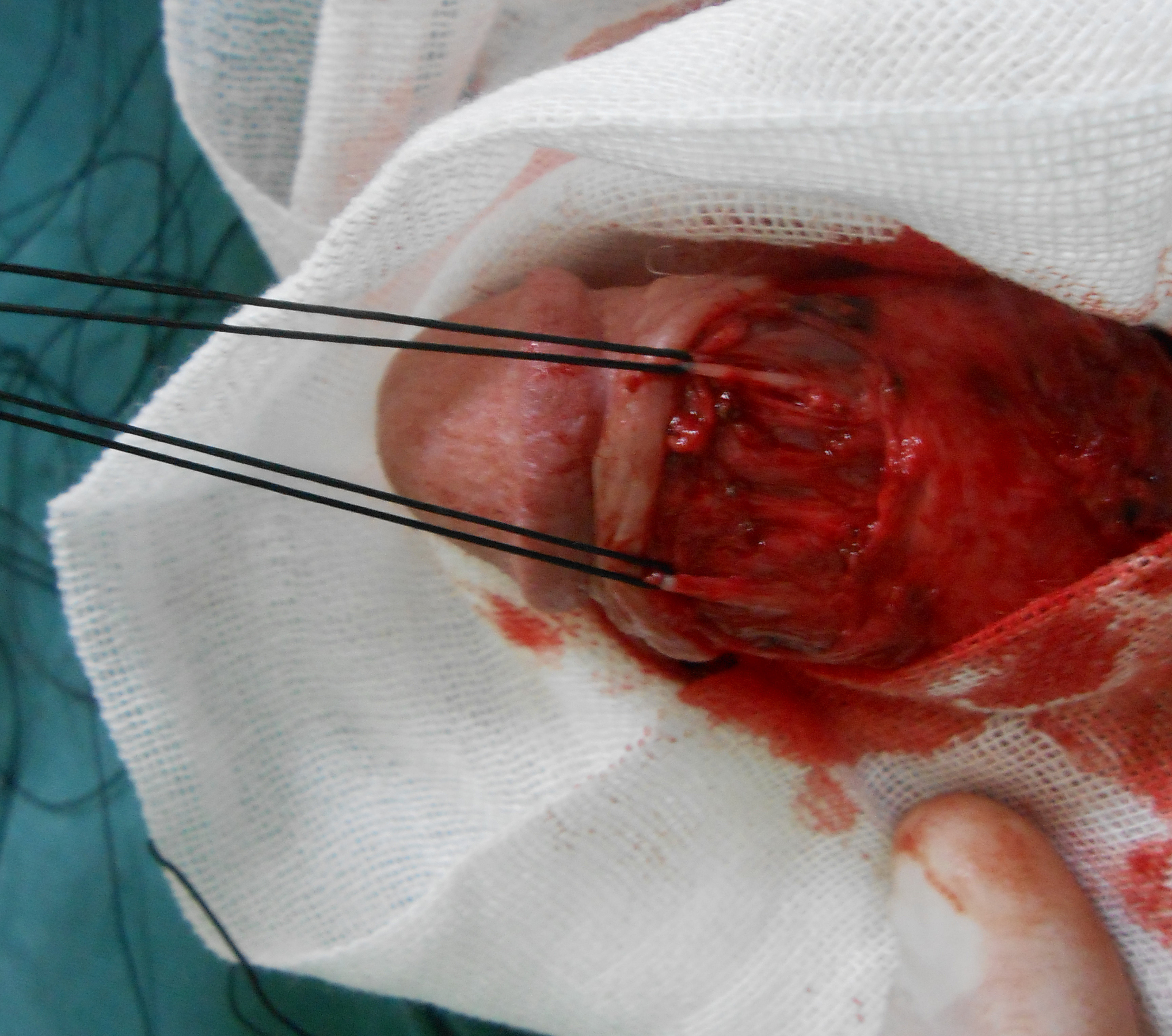 选择性阴茎背神经阻断术治疗早泄的临床体会(