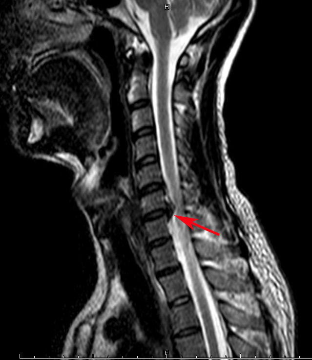 术前矢状位核磁共振显示颈椎 , 椎间盘右侧型突出,脊髓受压