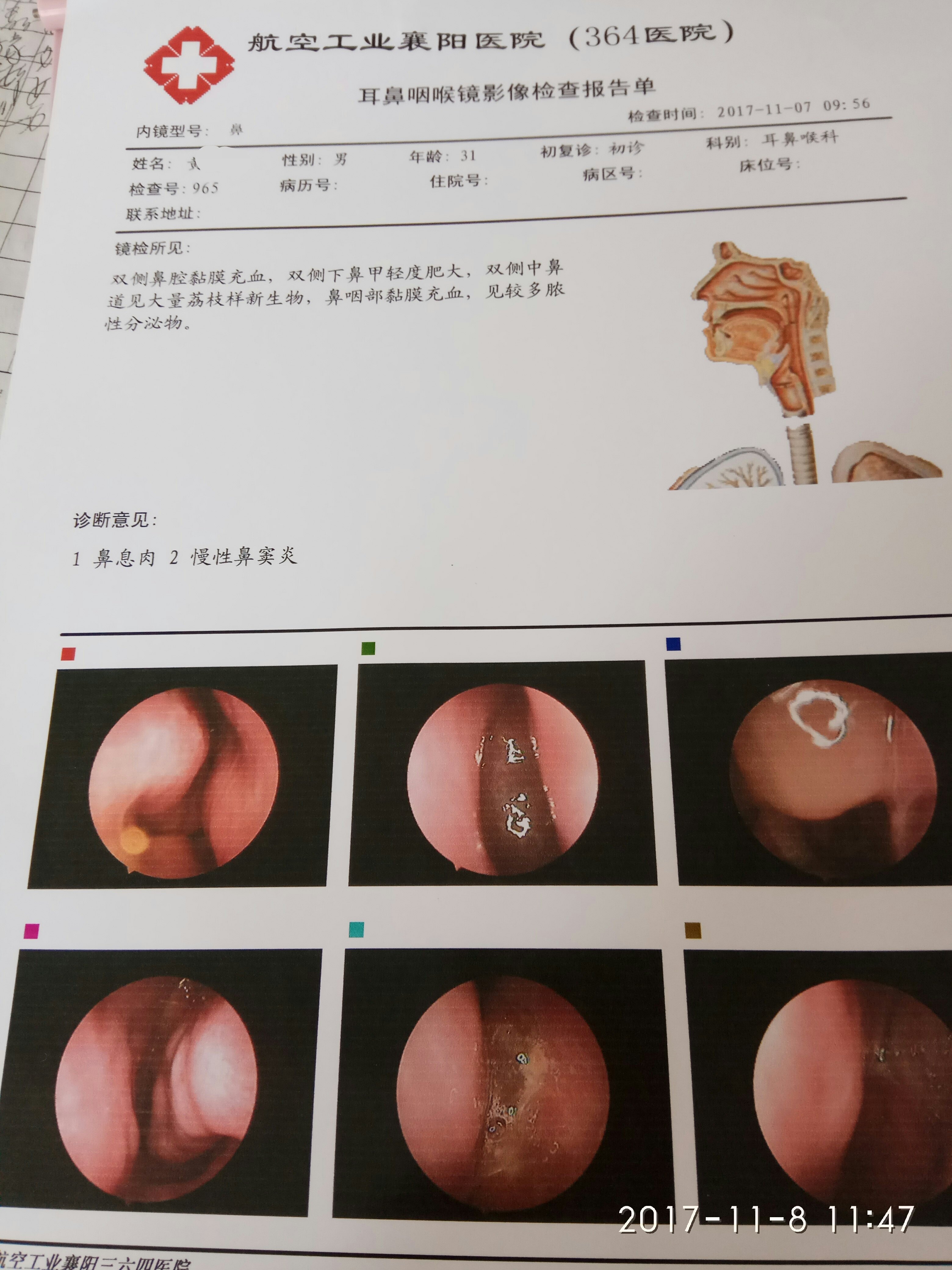 余胜朝 文章列表  门诊碰到慢性鼻炎_鼻窦炎患者,总会迫切地问,医生