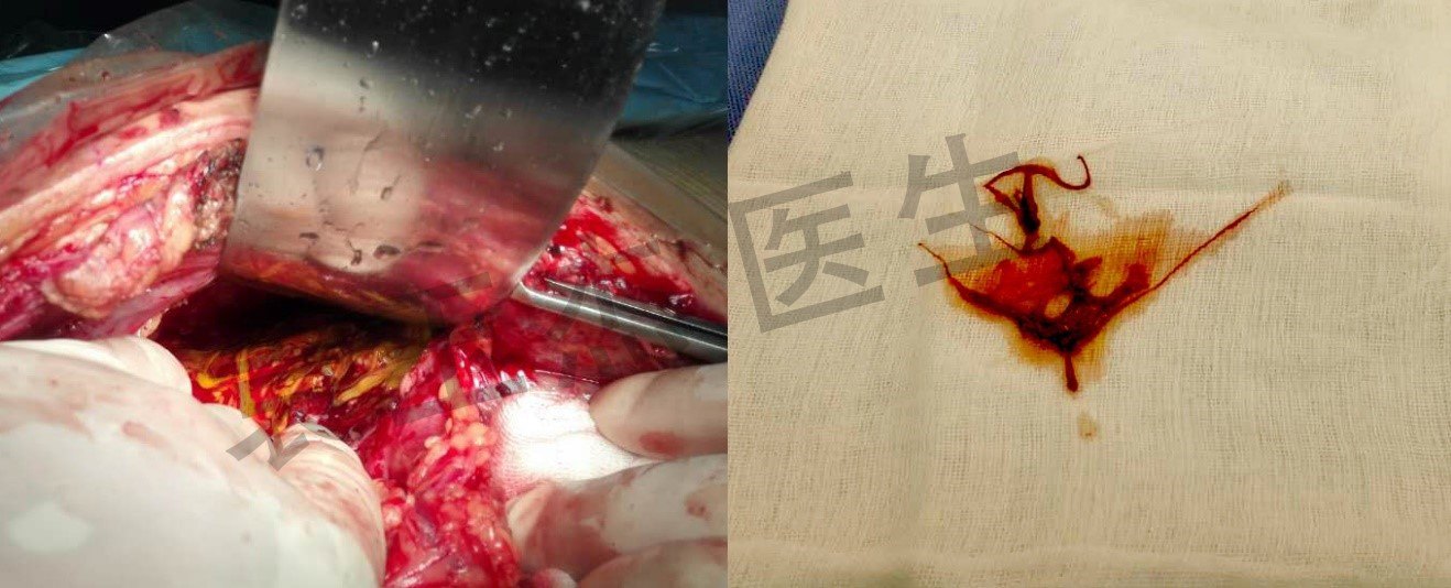 第二次术中探查及补片降解物取出(补片培养示阴沟肠杆菌,铜绿假单胞