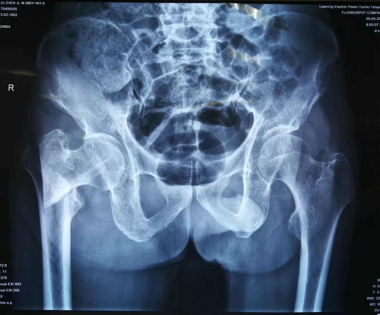 高龄患者骨质疏松髋部骨折分型不同术式不同