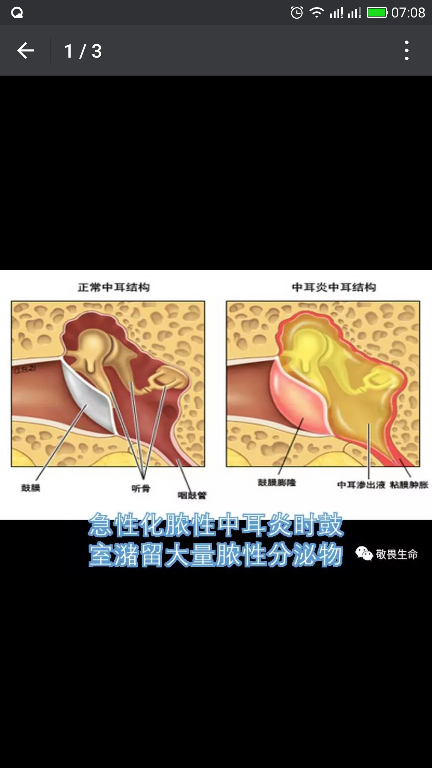患急性化脓性中耳炎时怎样滴药