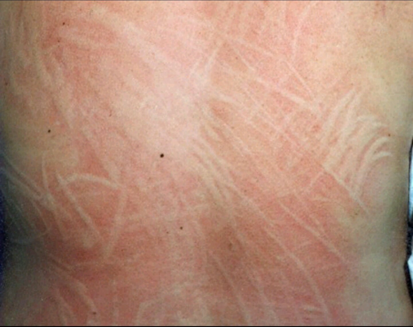 荨麻疹 越挠越痒越挠越痒の药物击破攻略 - 好