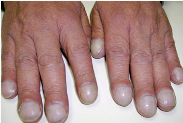 指甲里的秘密:指甲异常与全身性疾病 作者:rain