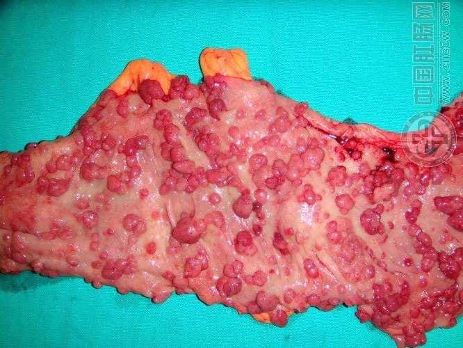 什么是家族性腺瘤性息肉病(FAP)?应该如何治