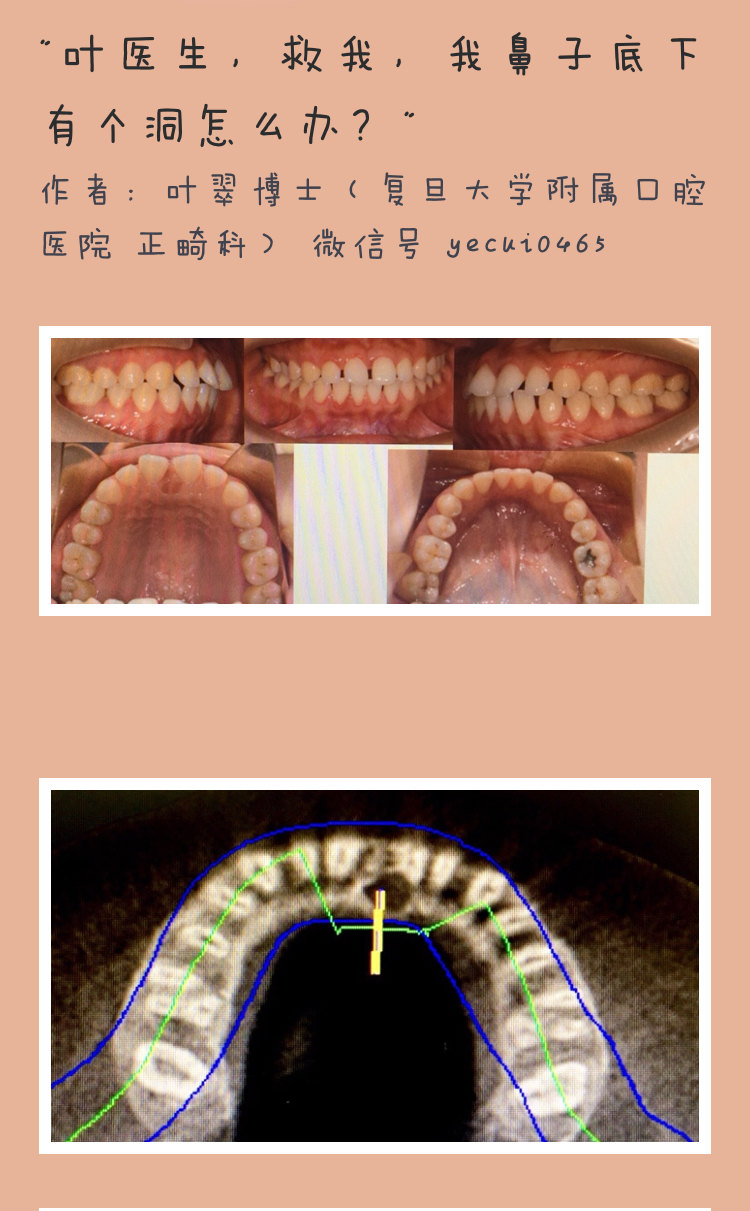 鼻腭管还是囊肿?