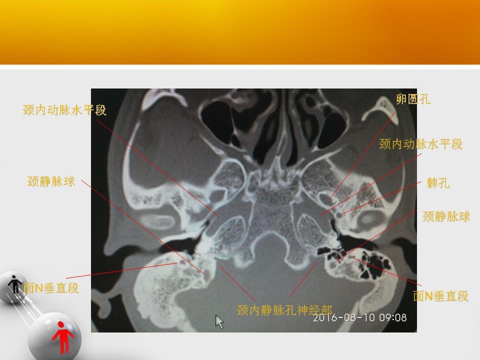 原创 颞骨断层轴位ct(完整篇)安阳市中医院耳鼻咽喉科